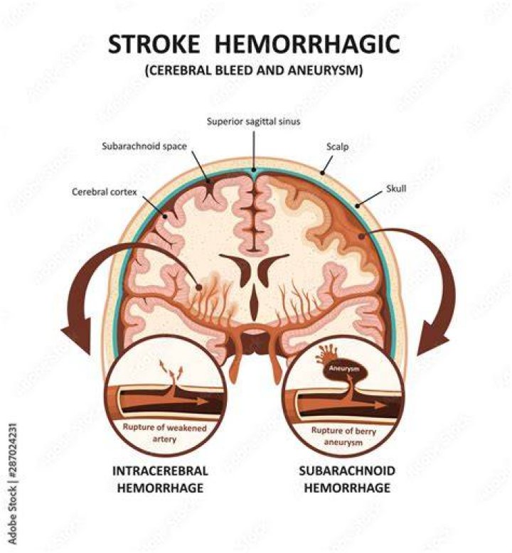 Are brain bleed and stroke the same?