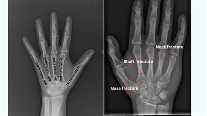 Can a broken metacarpal heal without a cast?
