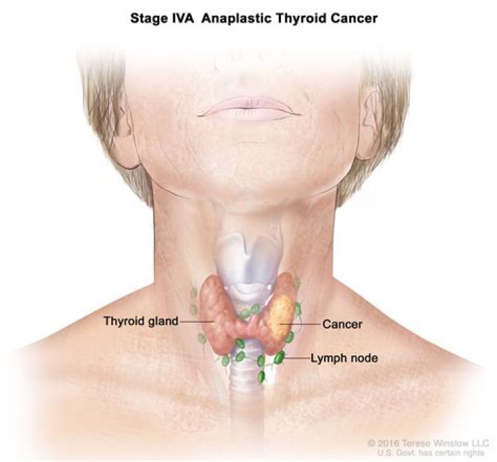 Can anaplastic thyroid cancer be cured?