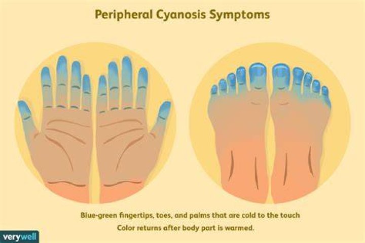 Can cyanosis kill you?