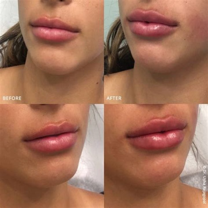 Can lip fillers look good?