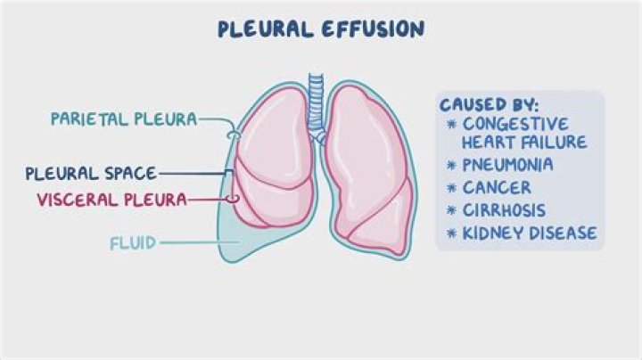 Can pleural effusion cause pneumonia?