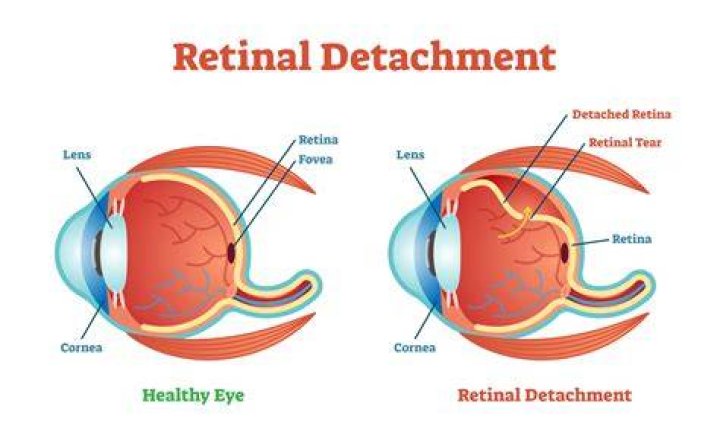 Can you fly with a detached retina?