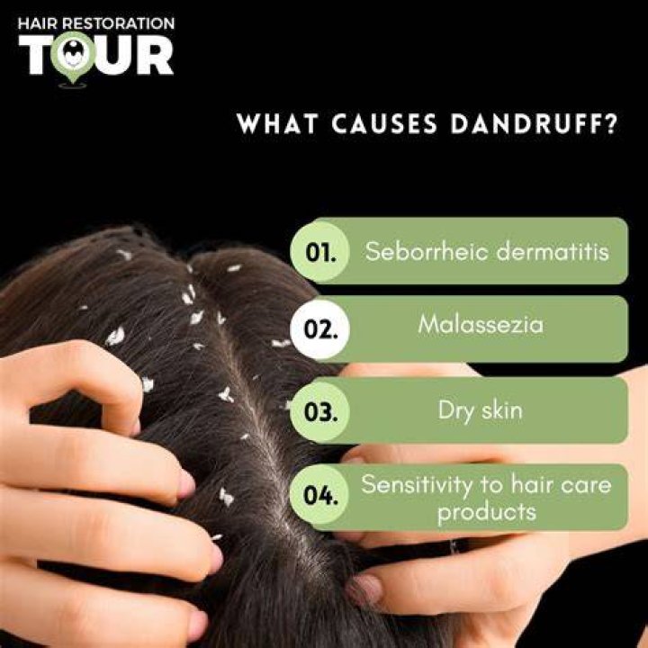 Do dandruff cause hair fall?