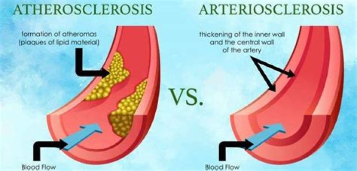 Does atherosclerosis cause arteriosclerosis?