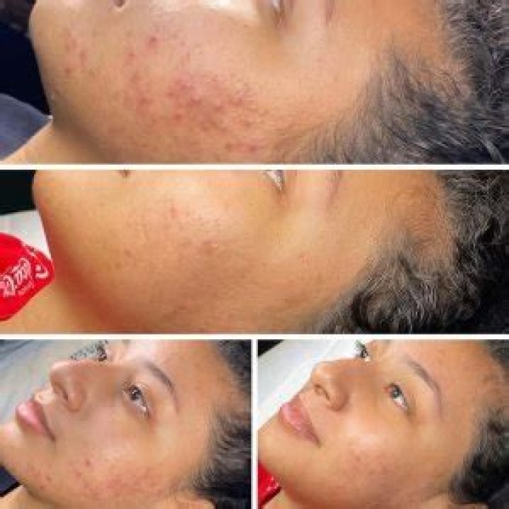 Does bha help with acne scars?