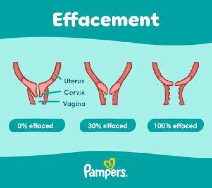 Does effaced mean in pregnancy?
