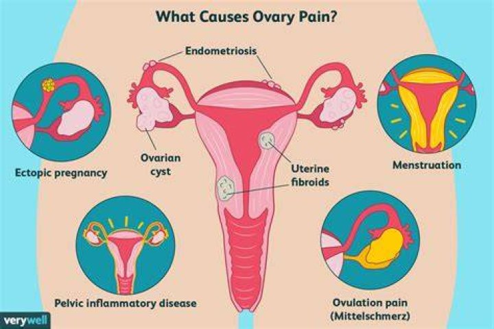Does polycystic ovaries cause back pain?