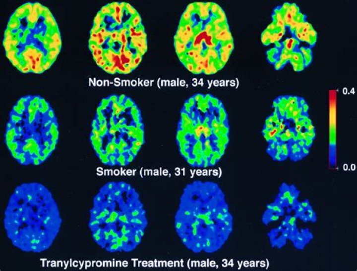 Does smoking cigarettes kill brain cells?