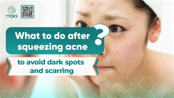 Does squeezing spots cause scars?