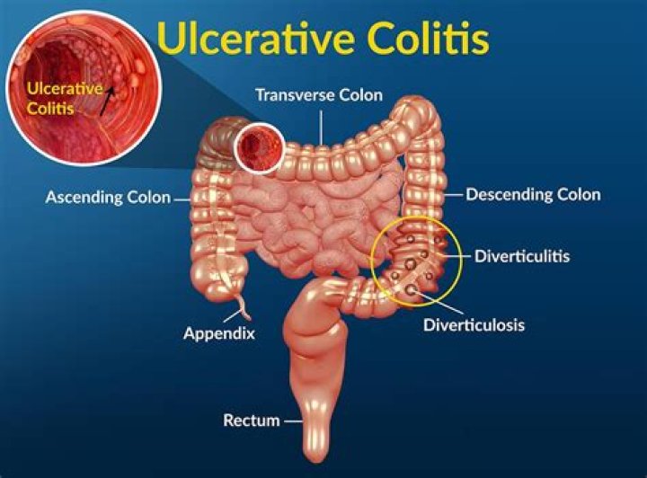 How can ulcerative colitis be cured?