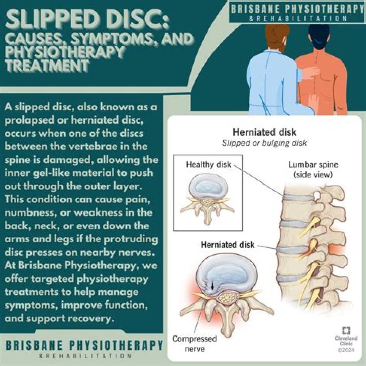How to fix a slipped disc?