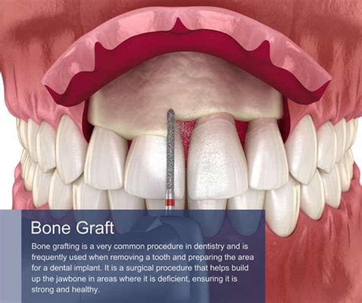 Is a bone graft surgery?