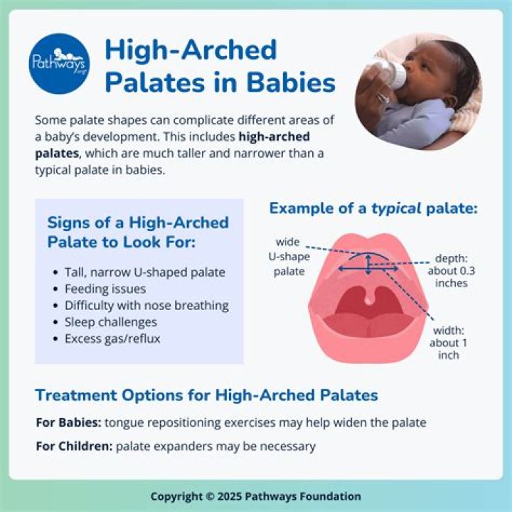 Is high arched palate genetic?