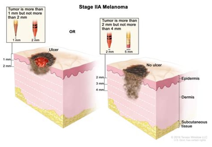 Is melanoma surgery outpatient?