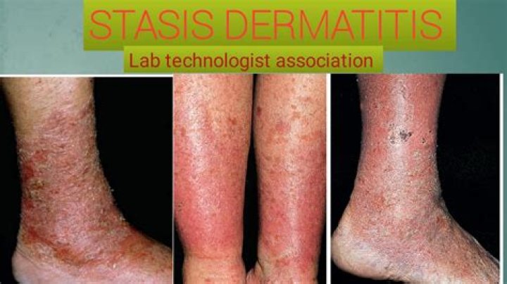Is stasis dermatitis painful?