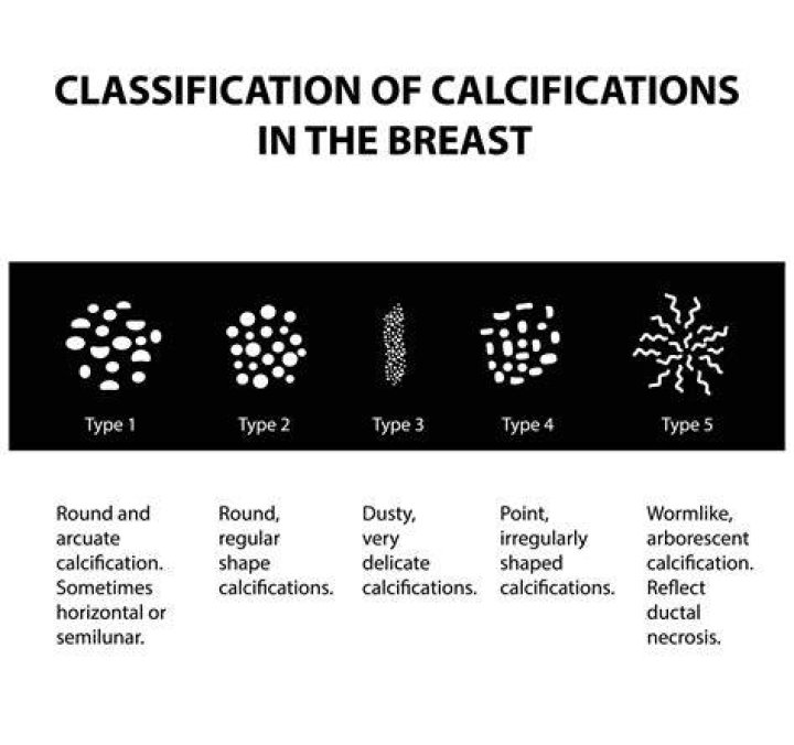 Should calcifications in breast be removed?