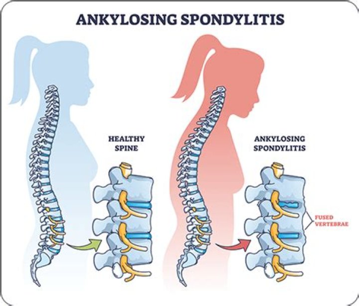 Was ist ankylosing spondylitis?