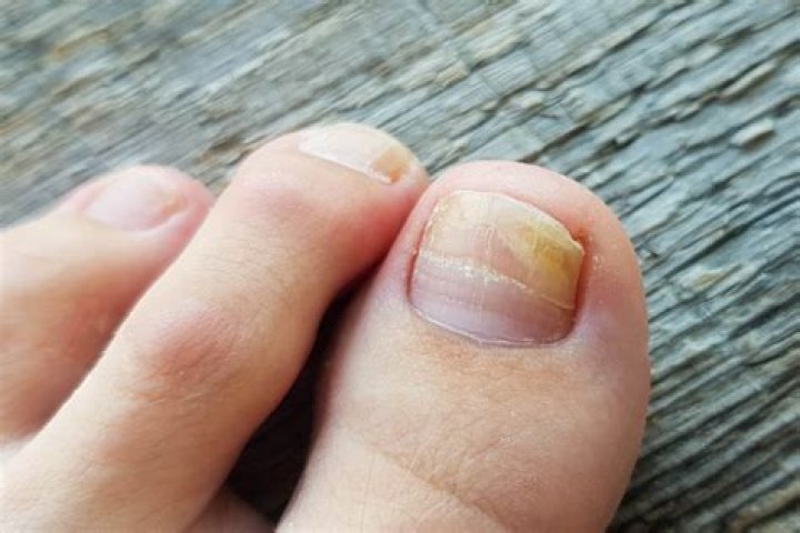 What causes nails to delaminate?