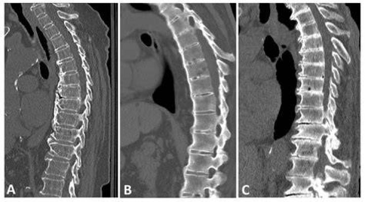 What is ankylosing hyperostosis?