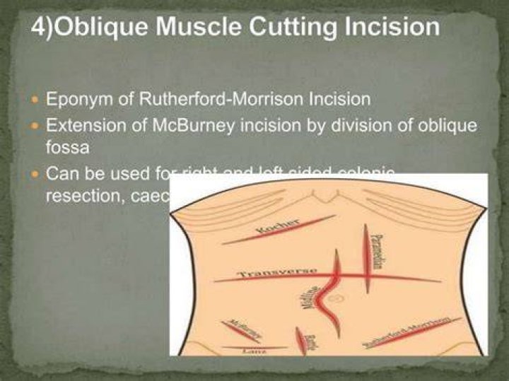 What is rutherford morison incision?