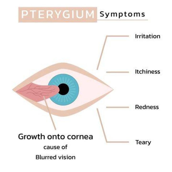 When to refer pterygium?