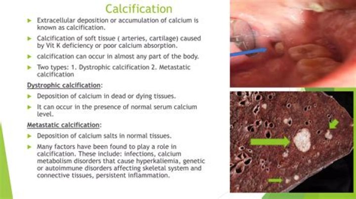 Where can calcification be found?