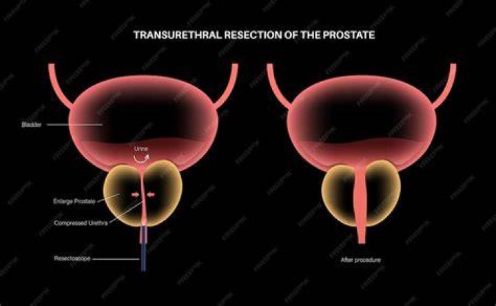 Which of the following is an instrument for transurethral removal of lesions?