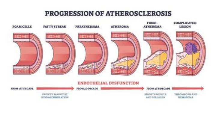 Why does atherosclerosis increase blood pressure?
