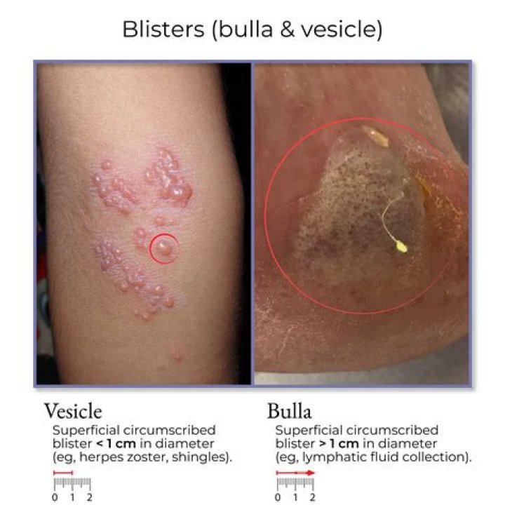 Why is bulla called bra?