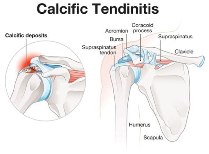 Will calcific tendonitis go away?
