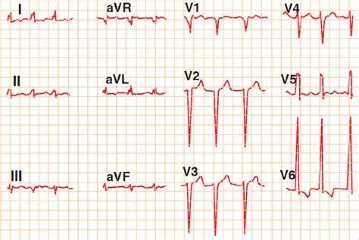 Will ekg show heart failure?