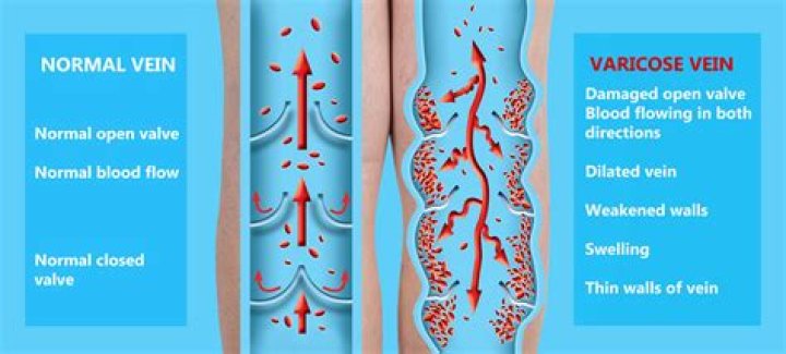 Will vein matting go away?